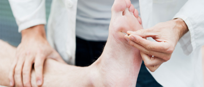 doctor pushing needle into ball of foot for neuropathy